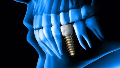 Best Dental Implants Clinic In Dubai